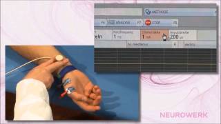 Motoric Neurography  Median Nerve [upl. by Timon147]