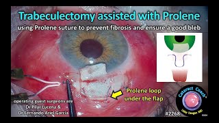 CataractCoach™ 2268 trabeculectomy assisted with Prolene suture [upl. by Nnyledam340]