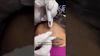 MOLLUSCUM CONTAGIOSUM REMOVAL by Dd Ayesha Faizan mollusca nagpurdermatologist [upl. by Ignatzia523]