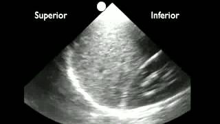 How to Ultrasound Detection of Pleural Fluid [upl. by Dukie775]