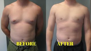 how to get rid of gynecomastia at home without surgery [upl. by Flight]