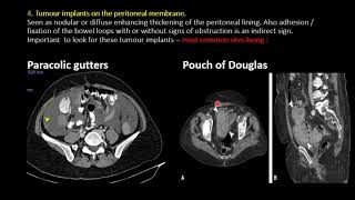 Imaging in Peritoneal Carcinomatosis [upl. by Cher]