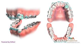 Orthodontic Treatment for Severe Crowding  Removing 4 Premolars [upl. by Hendon]