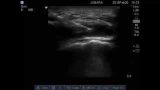 trochanteric bursitis injection [upl. by Adiene]