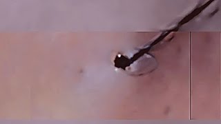 Removal of ingrown hair [upl. by Schnur1]