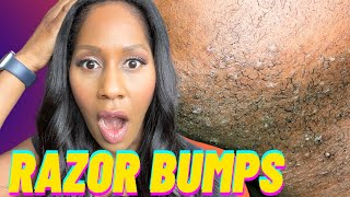 RAZOR BUMPS How to Get Rid of RAZOR BUMPS FAST A Doctor Explains [upl. by Harimas]