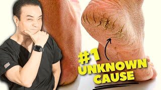 DONT DO THIS 7 Surprising Causes Of Cracked Heels [upl. by Annat379]