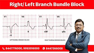 RightLeft Branch Bundle Block by Dr Bimal Chhajer [upl. by Dodie]