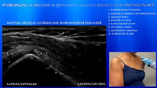 Ultrasound of a Mild Subdeltoid Bursitis with Calcific Bodies in the Overhanging Aspect of the Bursa [upl. by Singleton799]