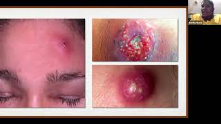 Common Dermatosis in Pediatric OP Practice  IAP Webinar [upl. by Ganley523]