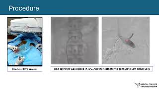 Dr Ajay Alex  Hepatic Melanoma  SMA Ceoliac and Post transplant renal stenting  PVE PARTO EVAR [upl. by Celina]