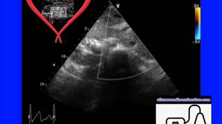 Ultrasound Board Review on Situs Inversus Corrected Transposition of the Great Arteries Ped Echo [upl. by Ecinert]