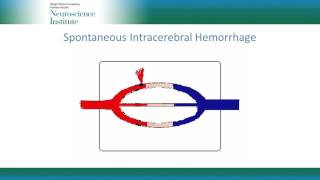 Management Principles for Spontaneous Intracerebral Hemorrhage [upl. by Eadwine246]