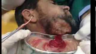 Hilton method for abscess Incision amp Drainage Subcutaneous تفجير خراج مسافة شدقية سني المنشأ [upl. by Macrae]