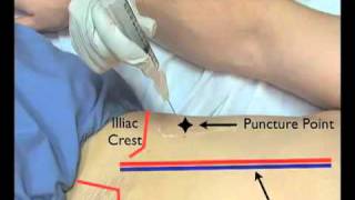 Paracentesis Ultrasound Guided EndoGastroHepnet [upl. by Callean]