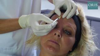 Frontalis Treatments with Botox [upl. by Tterrej426]