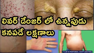 Liver Disease and Symptoms Detailed Video in Telugu [upl. by Aitnahs]