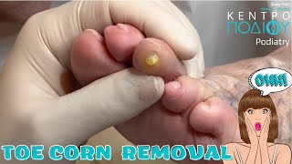 Toe Corn Removal feet toe κεντροποδιου foot podologos calluses podiatrist corn footcare [upl. by Ettelracs924]