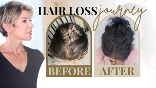 Hair Loss in Women Dr Approved Treatments Shampoos amp Thin Hair Hairstyles Tips  Dominique Sachse [upl. by Orsini]