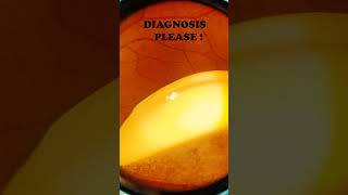 Diabetic retinopathy  Vitreous  Hard exudates  Fundus  Short Video 194 [upl. by Rebecka821]