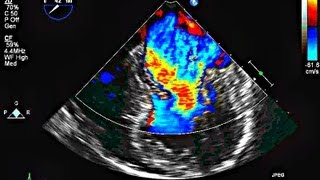 Mitral Valve Prolapse and Mitral Regurgitation  Echocardiography [upl. by Yelha19]