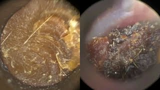 169  Ear Wax Removal in Young Child with Narrow Ears including off the Eardrum using the WAXscope®️ [upl. by Fredra]