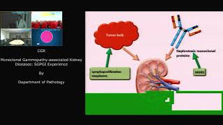 Monoclonal Gammopathy associated Kidney [upl. by Nylleoj]