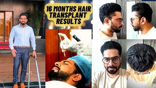 16 Months HSN Hair Transplant Results  Tamil Hair Transplantation  Ameer HT ameerht [upl. by Llovera]