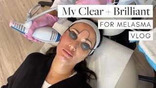 My Clear  Brilliant Laser Treatment for Melasma with Dr Nina Desai  Susan Yara [upl. by Alexandria]