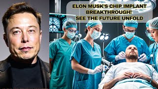 Segundo implante de chip cerebral da Neuralink de Elon Musk é concluído [upl. by Sissie]