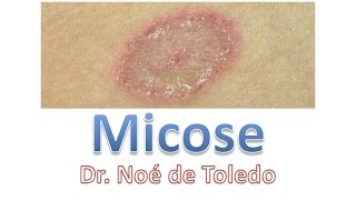 Micose  Dr Noé de Toledo [upl. by Frasier930]