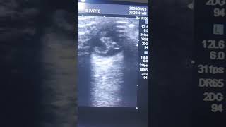 ultrasound eye  primary hyperplastic vitreous [upl. by Alfi687]