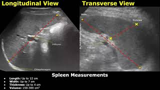 How To Measure The Spleen On Ultrasound  Splenic Length Width Thickness amp Volume Measurements USG [upl. by Healey]