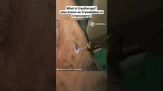 What is Cryotherapy also known as Cryoablation or Cryosurgery [upl. by Llehcim]