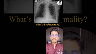 What’s the abnormality in Xray pulmonology radiology icu [upl. by Asenav152]