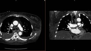 What To Do When You Notice A Filling Defect [upl. by Hummel759]