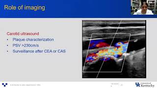 Interventions for Carotid Stenosis Where Do We Stand in 2024  American Academy of Neurology [upl. by Noval813]