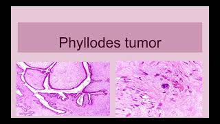 Phyllodes Tumor of Breast [upl. by Repsihw]