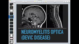 Transverse Myelitis Neuromyelitis Optica Acute Disseminated Encephalomyelitis  Neurology Course [upl. by Padraig]