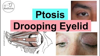 Ptosis Drooping Eyelid  Eye Anatomy Causes Associated Conditions Diagnosis amp Treatment [upl. by Funch]