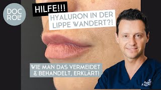 HILFE HYALURON in den LIPPEN WANDERT nach oben – Dr Rolf Bartsch [upl. by Anitrebla]