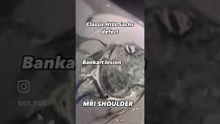 hillsach lesion bankart lesion mri shoulder radiology dislocation [upl. by Marlyn702]