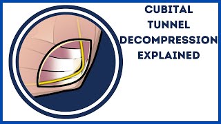 Cubital Tunel Decompression  Ulnar Nerve Release Explained [upl. by Attenoj350]