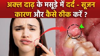 Pericoronitis Treatment At Home Akal Daad Ke Masude Fulne Ka Ilaj Wisdom Teeth Gum Swelling Remedy [upl. by Rizzo568]