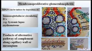 Membranoproliferative glomerulonephritis [upl. by Nalhsa]