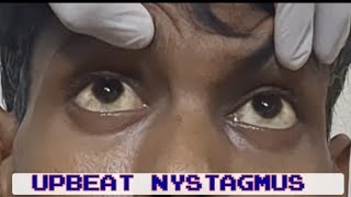 UPBEAT NYSTAGMUS in 1min  Causes amp CNS localization  mbbs medicine neurology [upl. by Remmer]