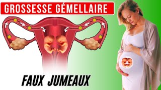 Grossesse gémellaire mécanisme de formation des faux jumeaux [upl. by Thessa]