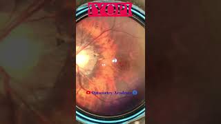 Myopic Fundus  Fundus Photography  Myopic Crescent  Short Video 162 viral optometryacademy [upl. by Britney]