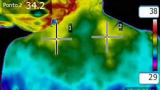 Neurofuctional Thermoguided Acupuncture  Acupuntura Neurofuncional Termoguiada [upl. by Adnuahsor]