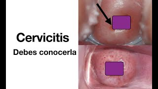 Cervicitis  Causas síntomas diagnóstico y tratamiento  ETS [upl. by Ayotnom]